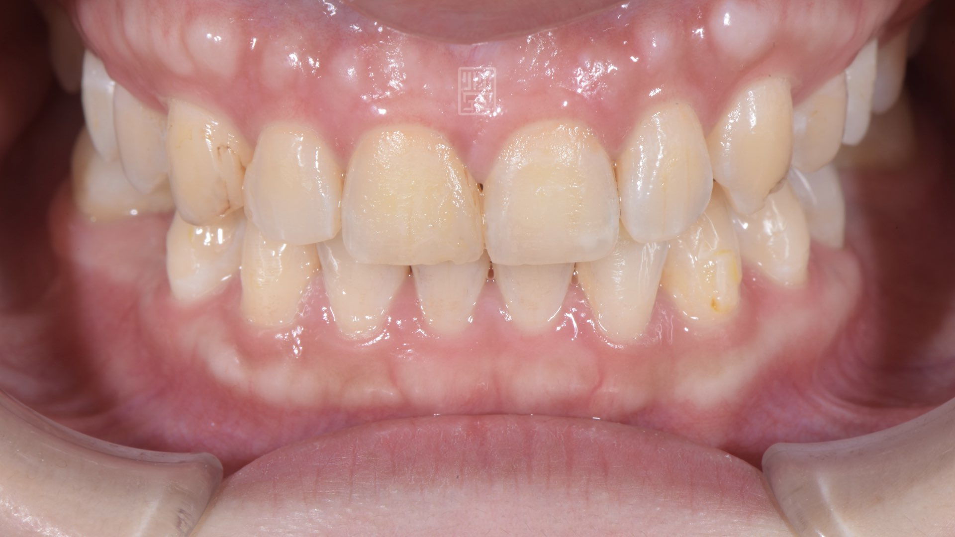 顏色偏黃，有局部樹脂填補變色