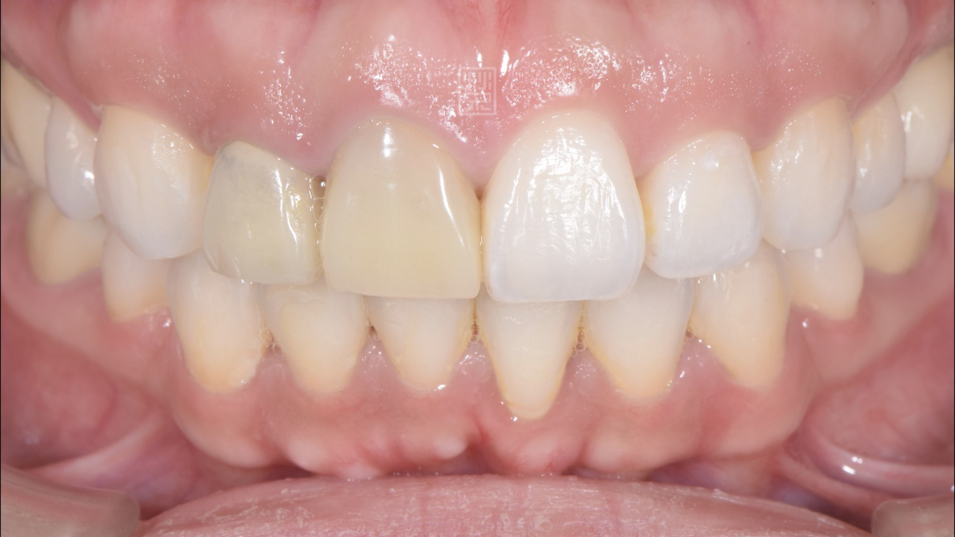 矯正後臨時假牙變色