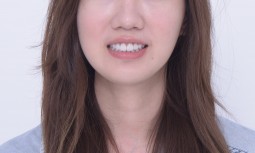 我覺得我笑起來不是很好看————牙齦整形併全瓷貼片