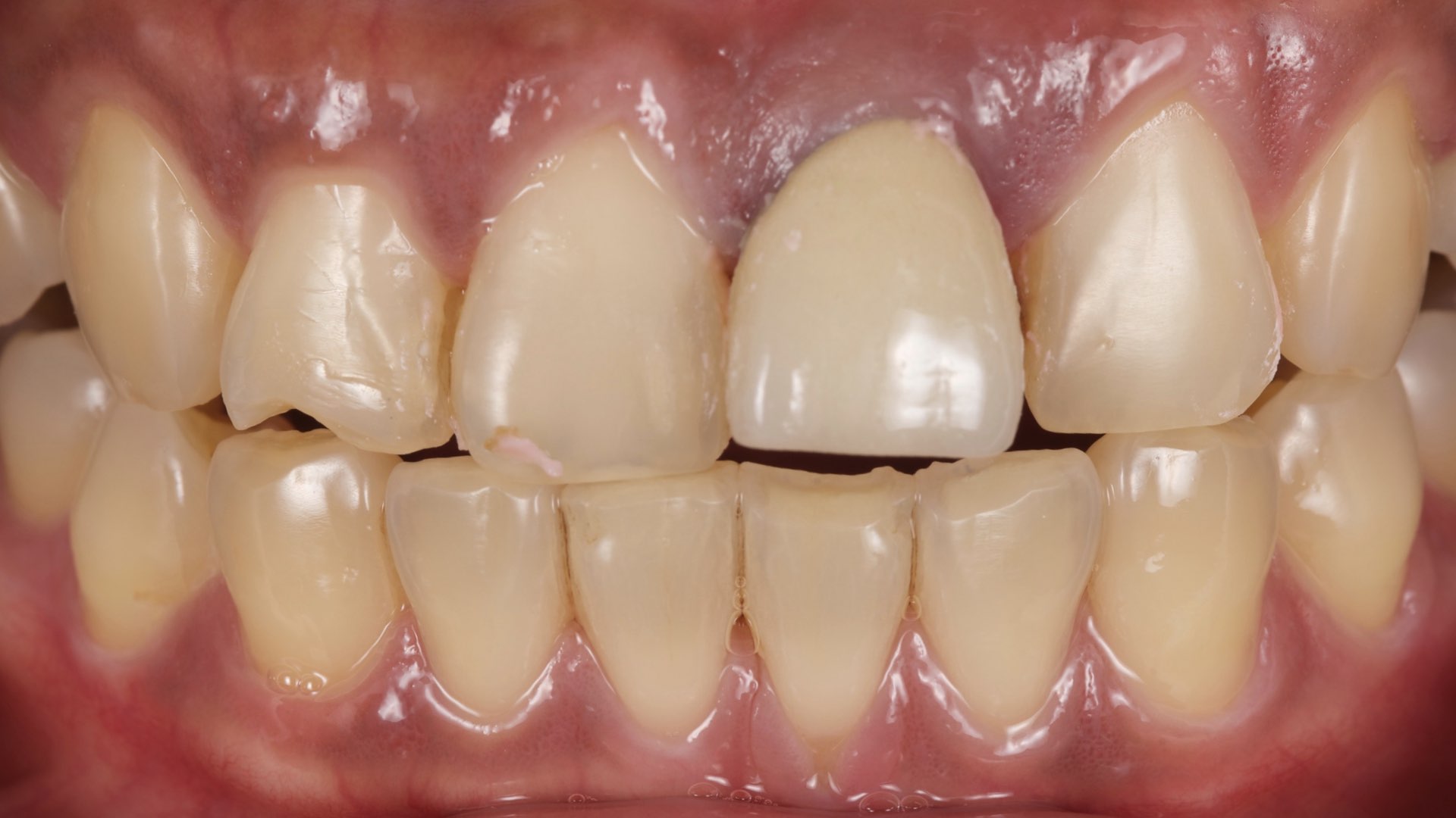 咬到硬物，牙齒脫出