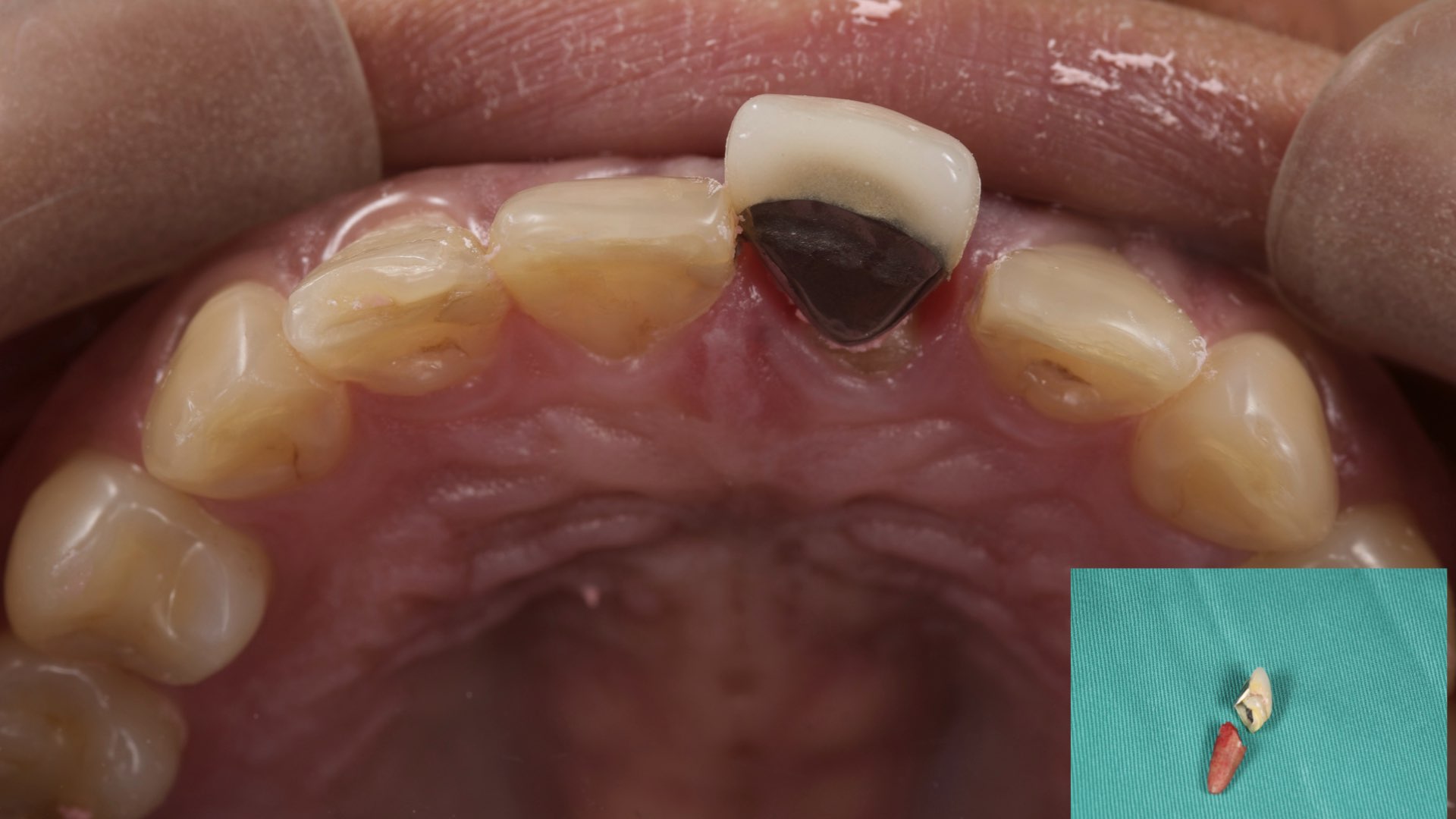 牙齒脫出，從齒頸部橫斷