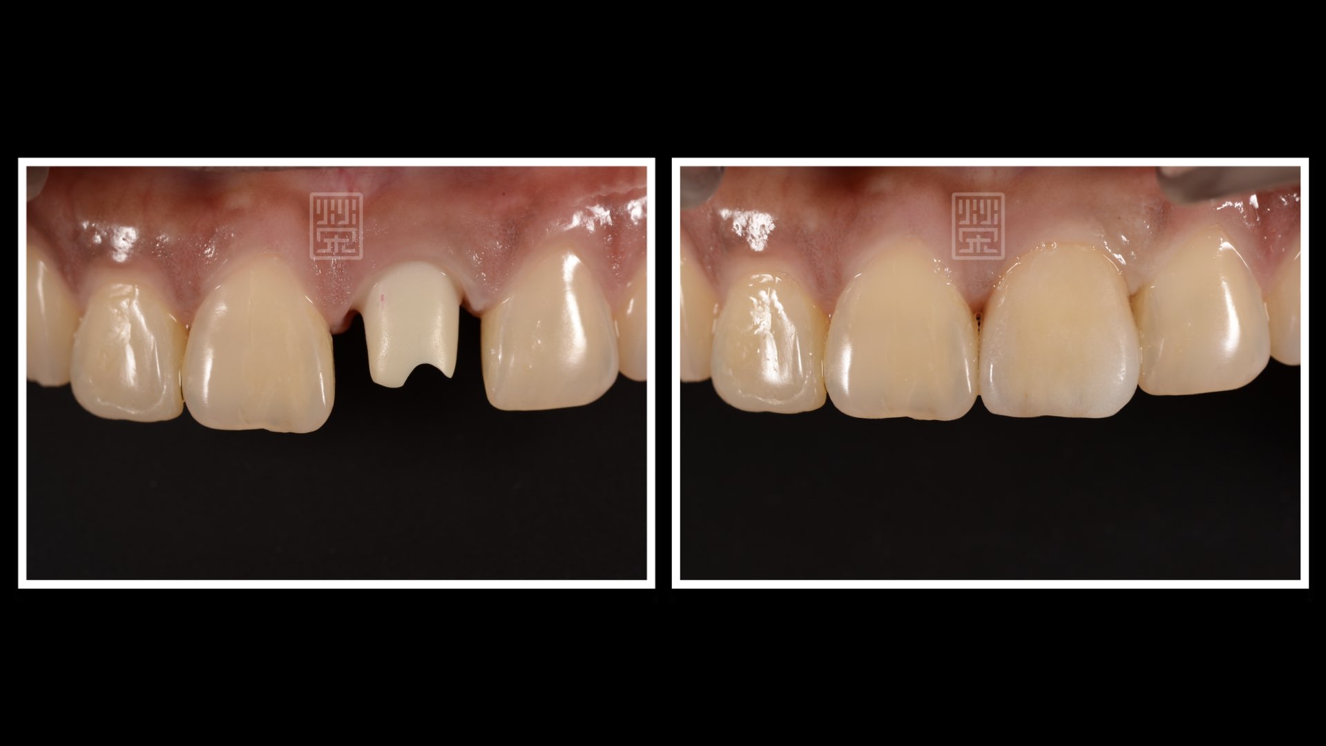 置換全瓷支台與全瓷冠