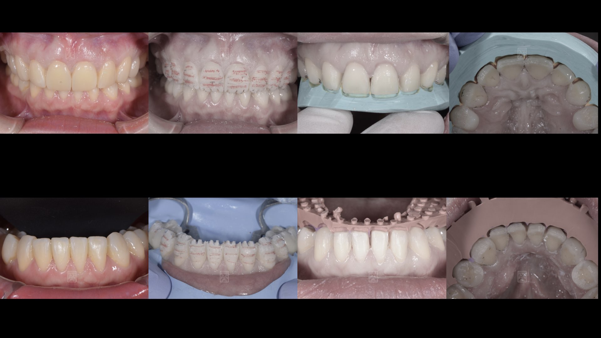 治療流程與精確修磨設定
