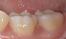 牙齒咬起來酸酸的---牙齒裂了