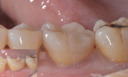 牙齒咬起來有點痛的---牙齒裂了