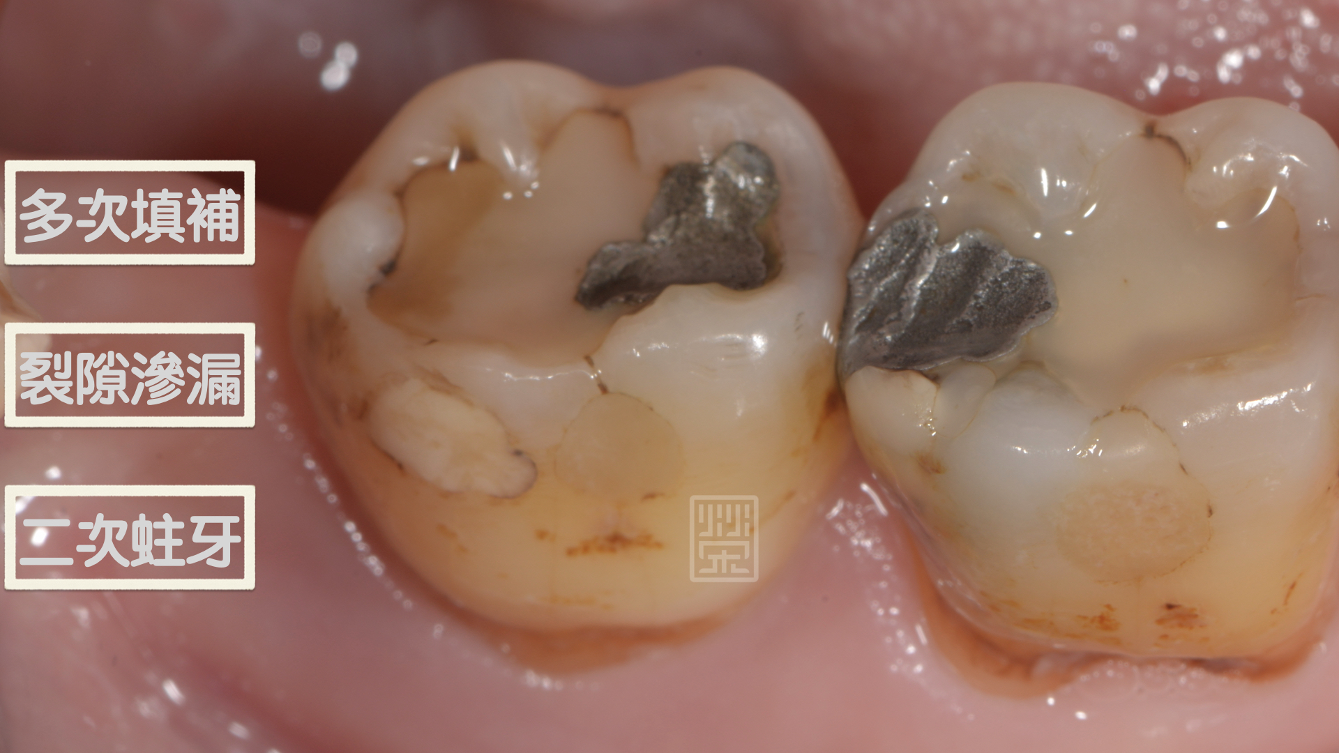 多次填補、多處蛀牙