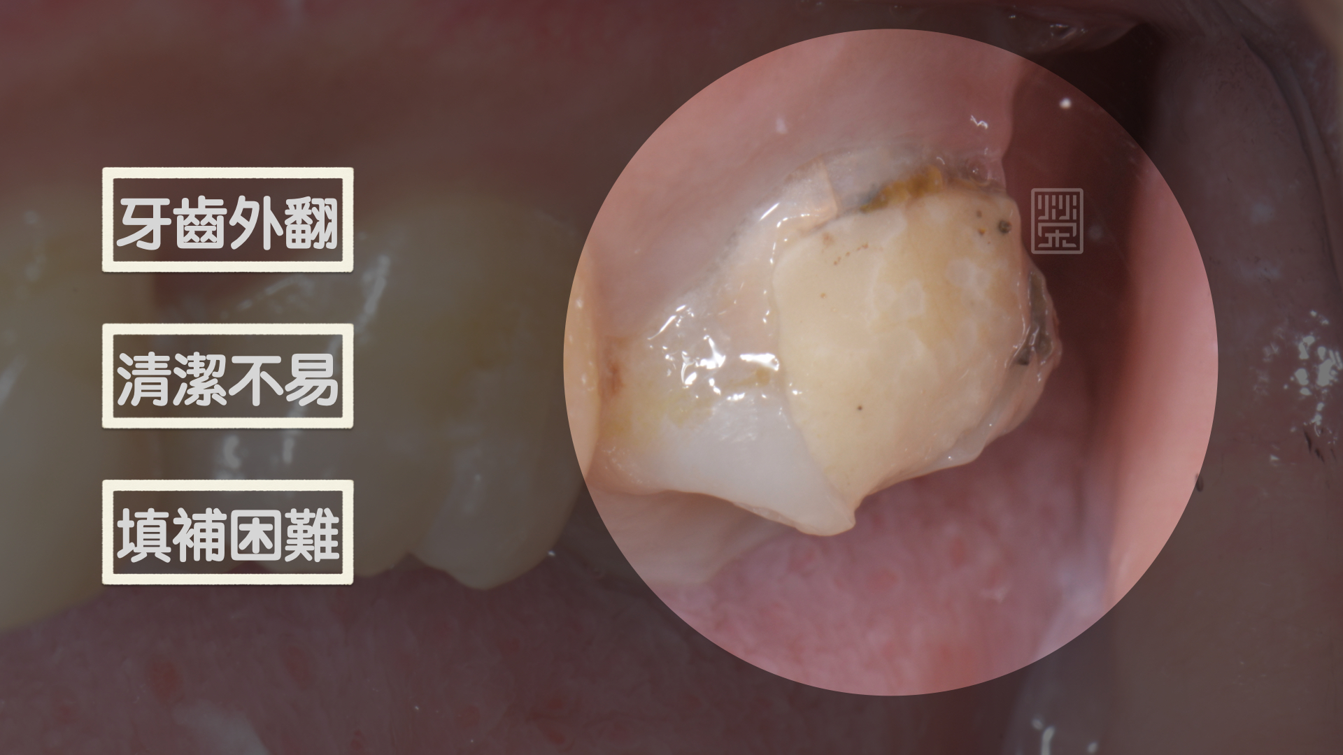 牙齒外翻，清潔不易