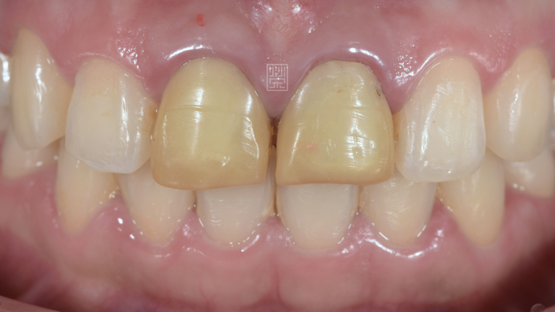 經歷矯正後，臨時假牙變黃