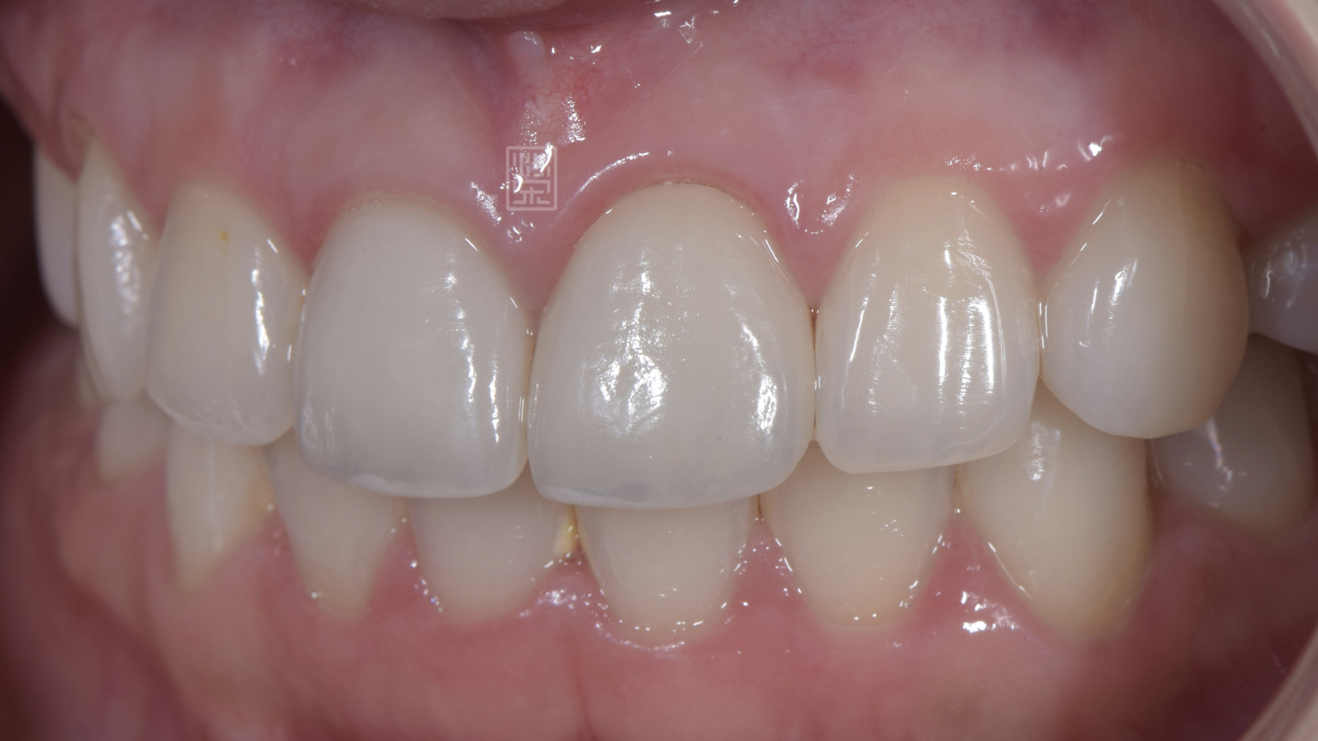 美白、全瓷冠完成