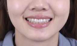 我的兩顆大黃牙怎麼辦？---美白全瓷冠修復