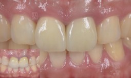 牙齒咬起來好痛，而且牙齒變長了------植牙全瓷冠修復