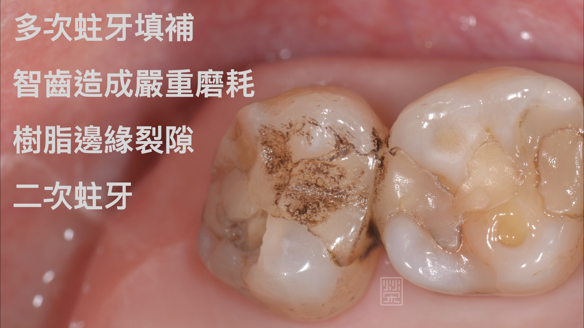多次填補、嚴重磨耗、邊緣裂隙、二次蛀牙