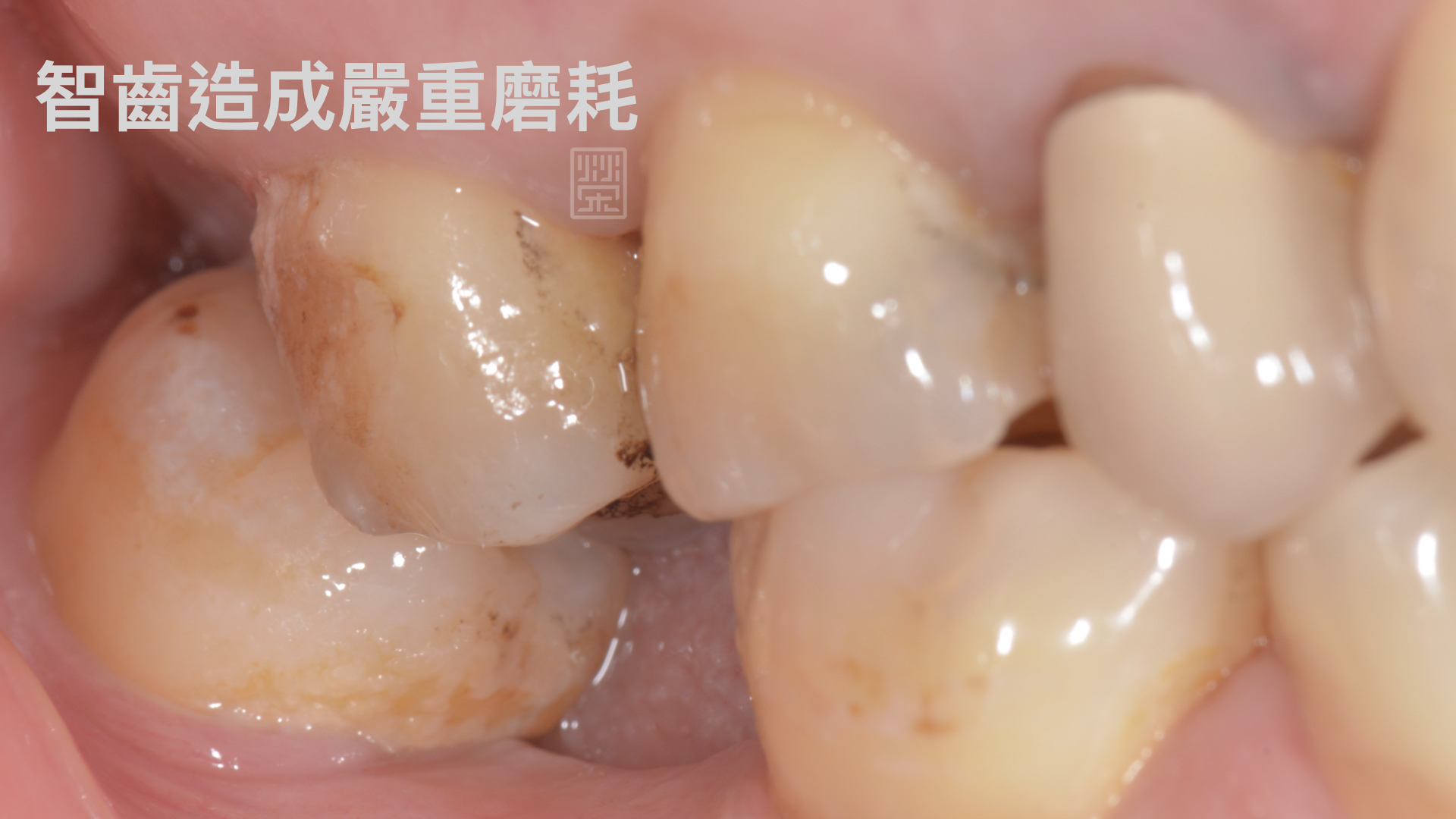 智齒造成嚴重磨耗