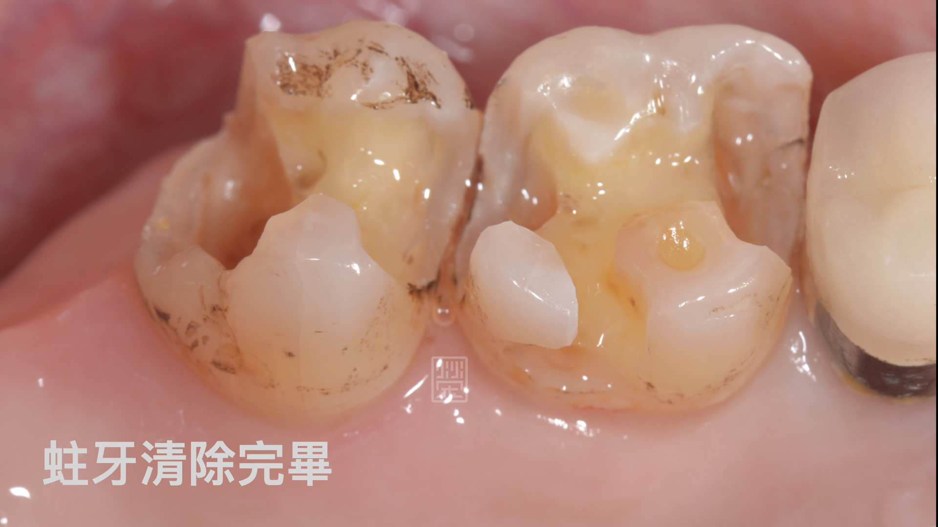 清除後齒質嚴重喪失