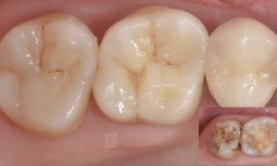 後面牙齒咬起來好痠痛，原來是智齒造成的問題------全瓷嵌體修復