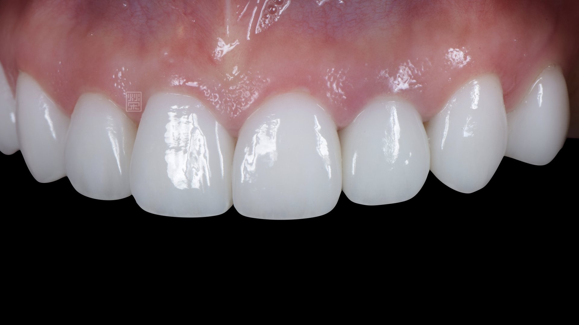 全瓷冠、貼片修復