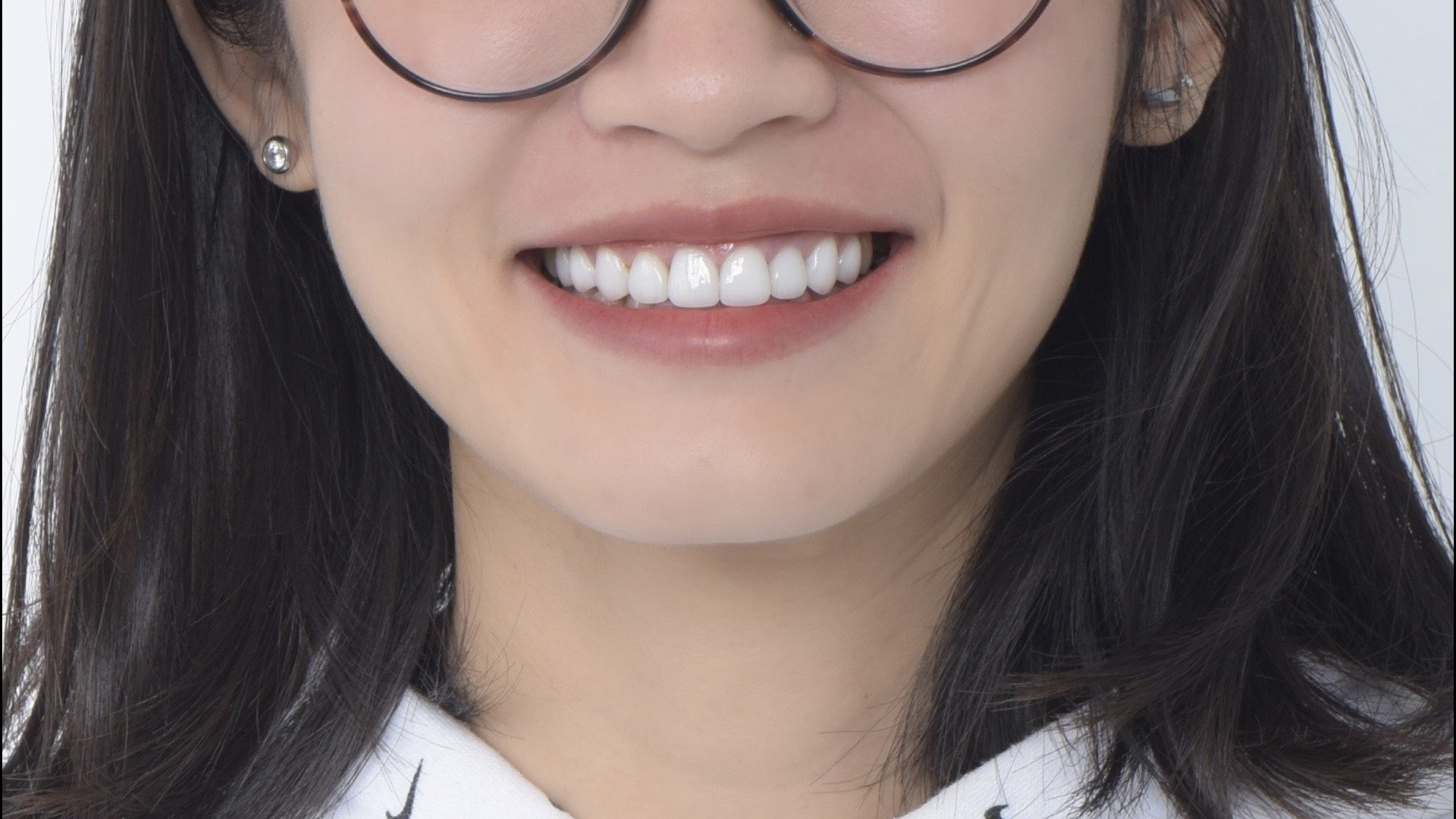 全瓷冠、貼片修復