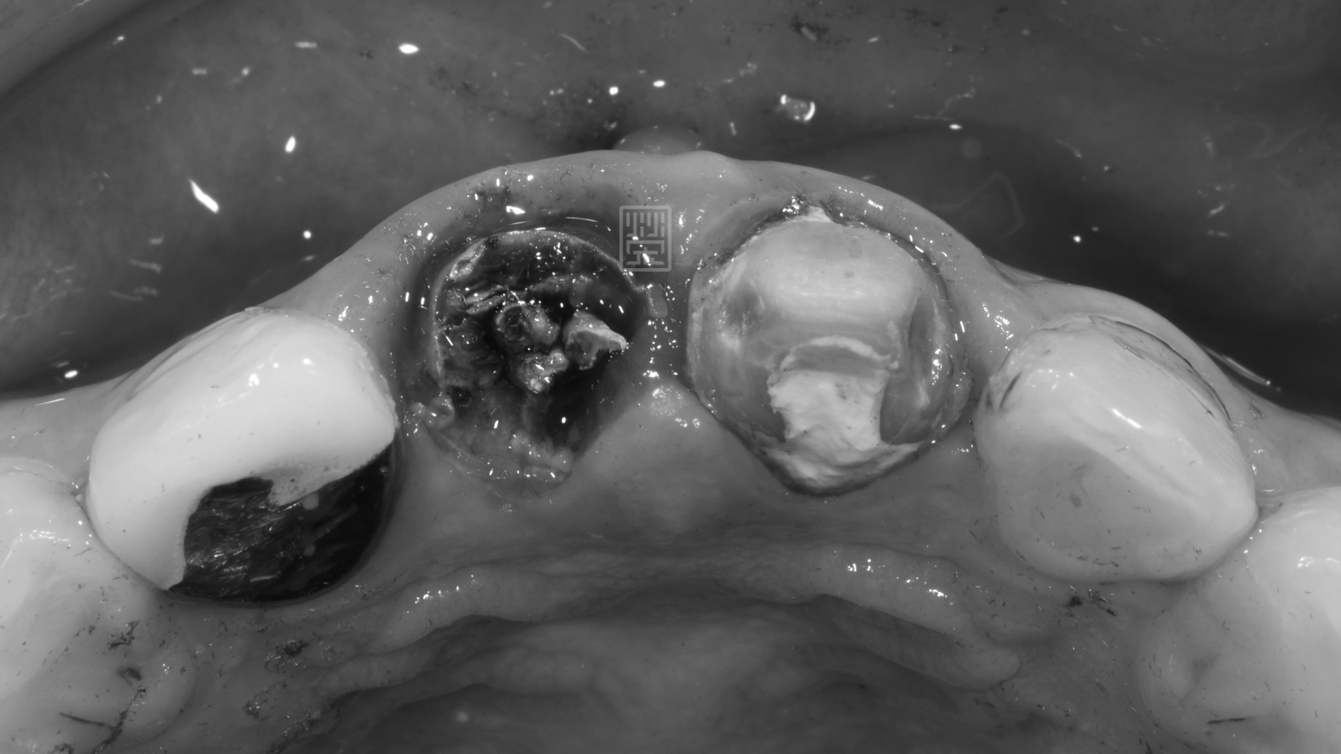 右邊門牙嚴重蛀牙