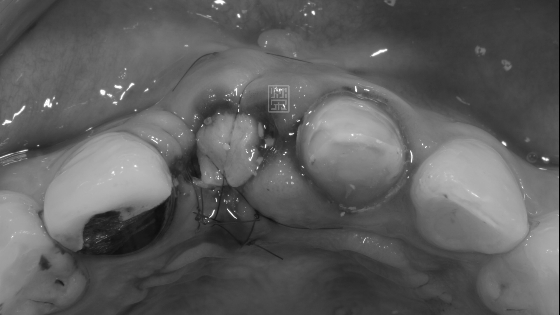 植牙手術合併牙齦轉移