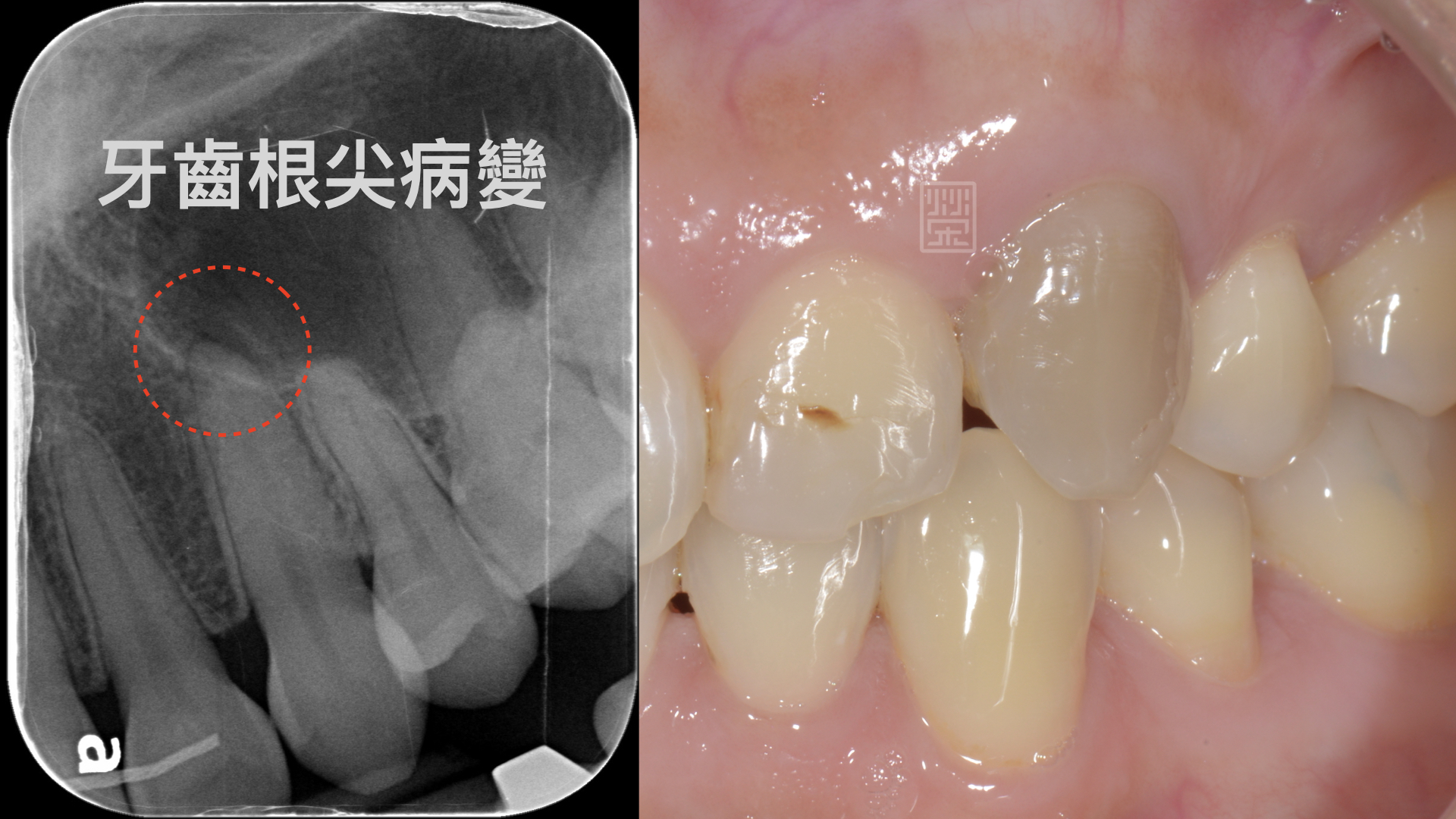 Ｘ光片中發現根尖陰影