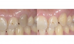 我的牙怎麼突然變黑了！！！---齒內美白