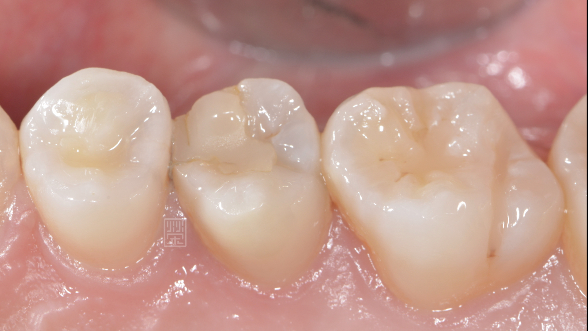 樹脂邊緣有隙縫