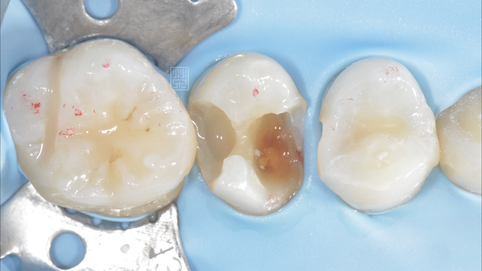 清除蛀牙後損傷嚴重