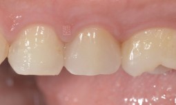 我的牙齒咬東西好酸啊---全瓷嵌體修復