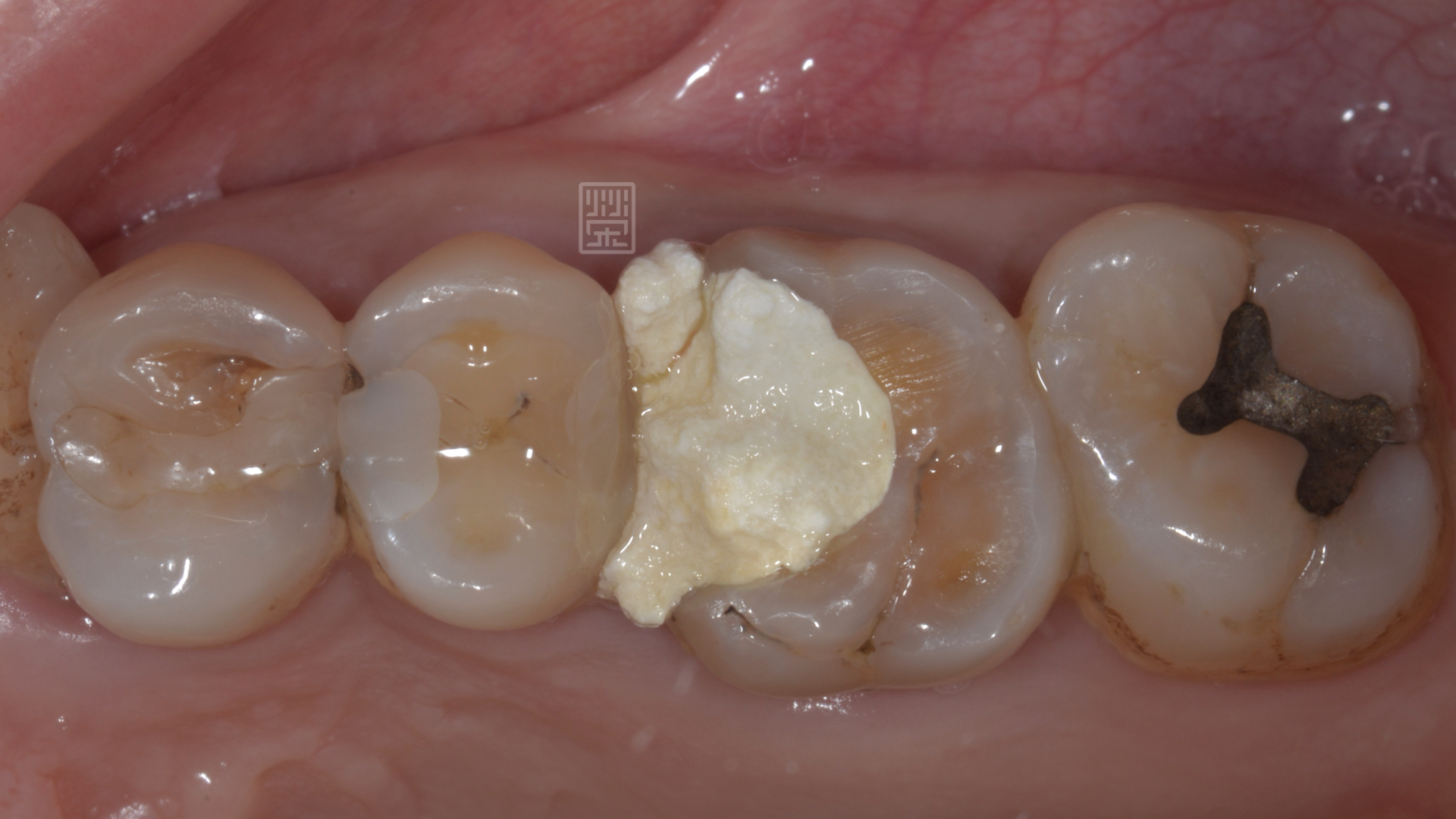 根管治療後大範圍缺損