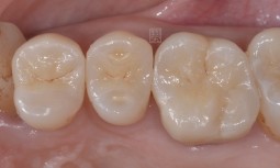 根管治療後怎麼辦？   全瓷嵌體修復