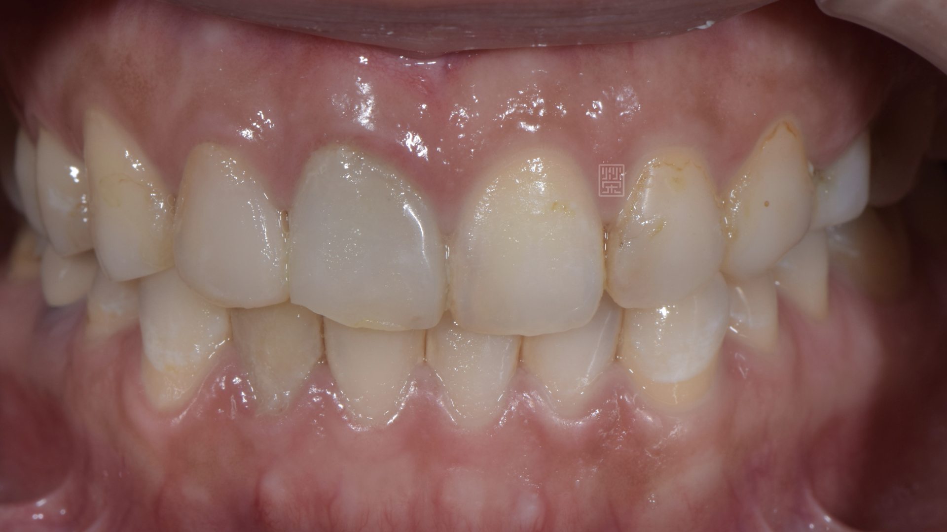 植牙後臨時假牙