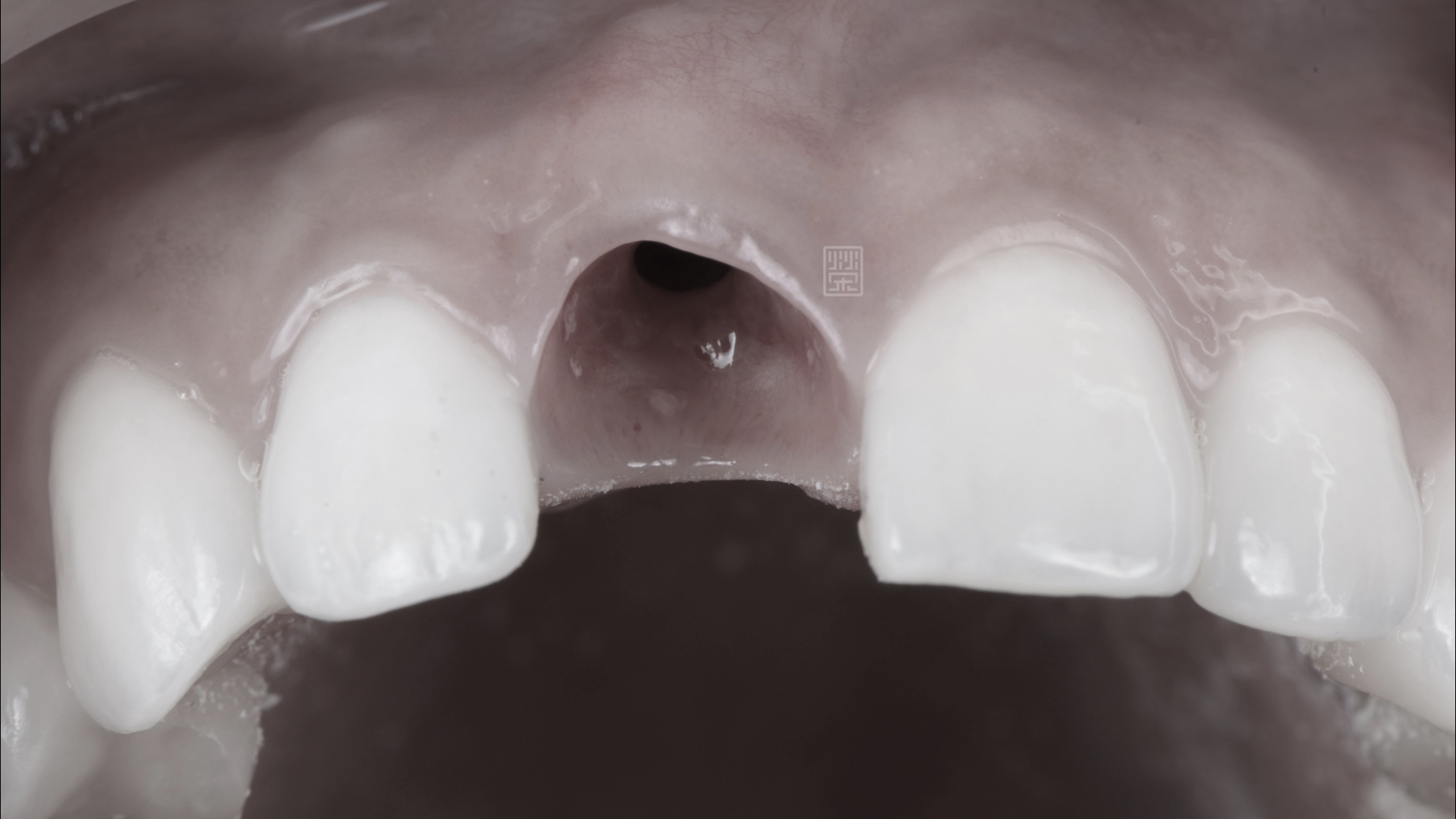 植牙周圍健康牙齦