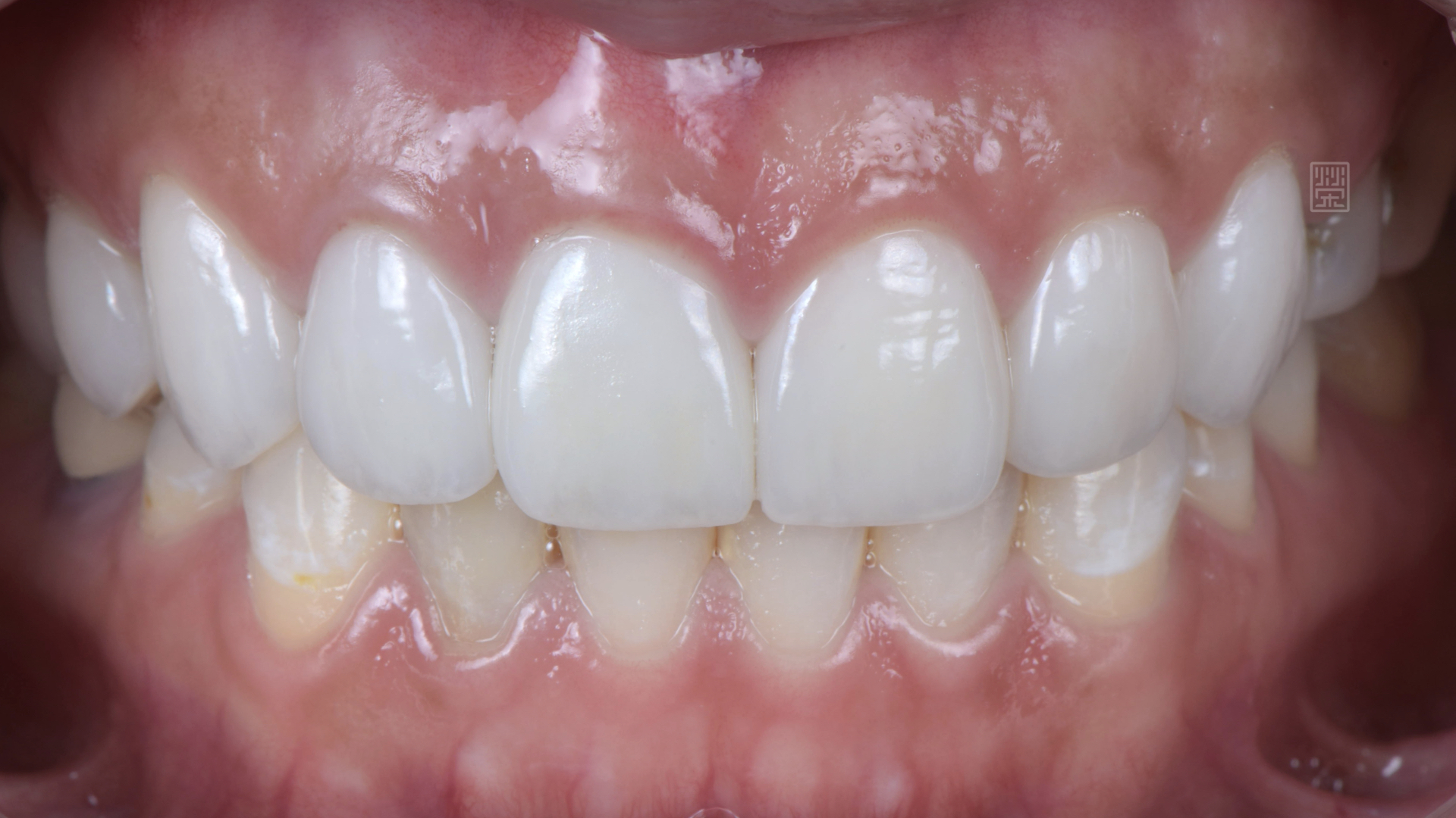 全瓷冠與貼片完成