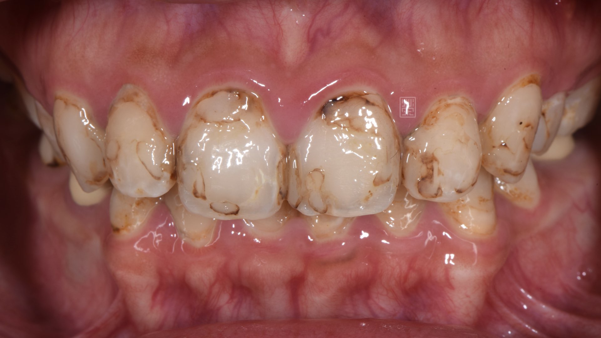 門齒多次蛀牙填補