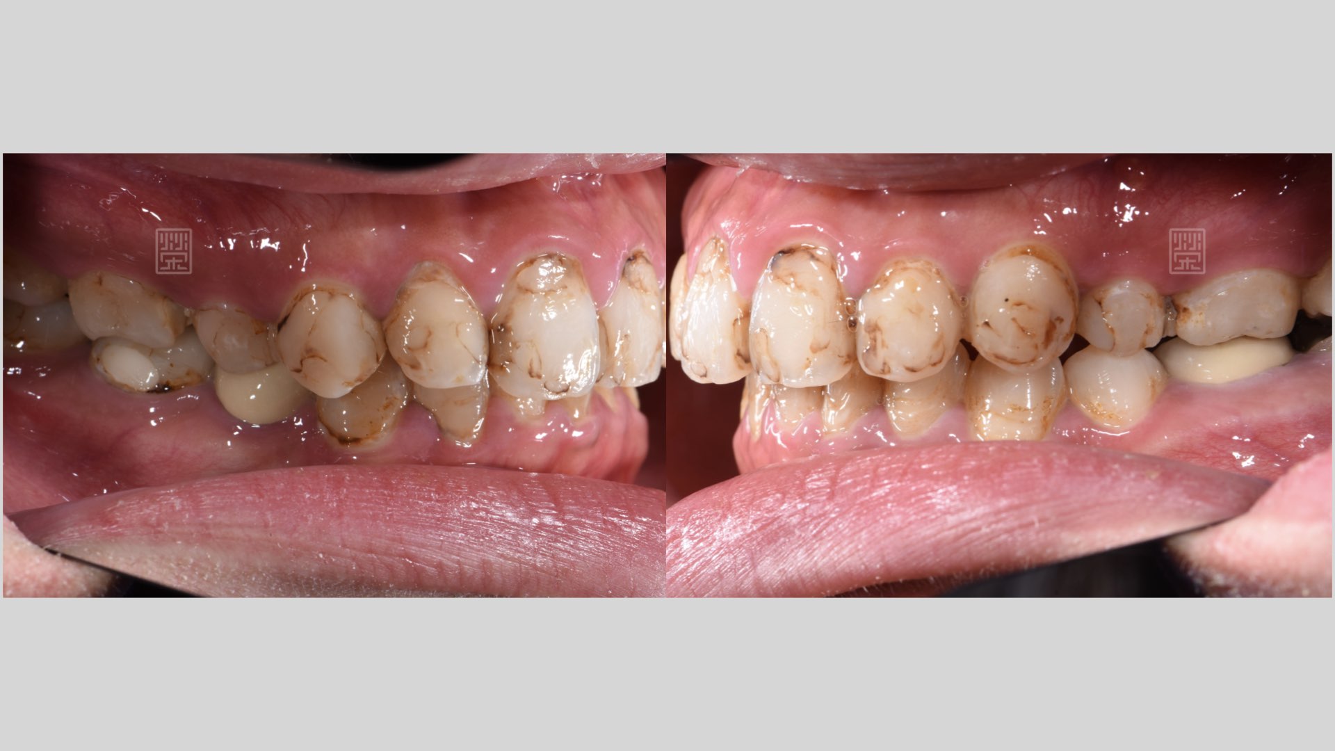 後牙多次蛀牙填補