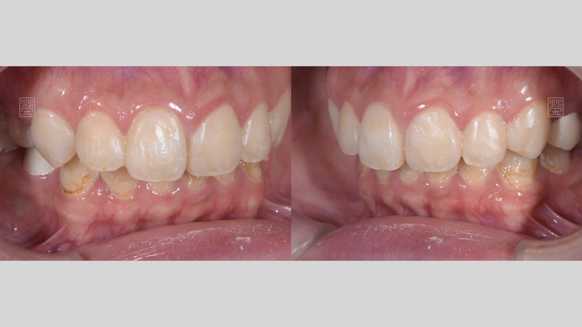 重新樹脂填補完畢