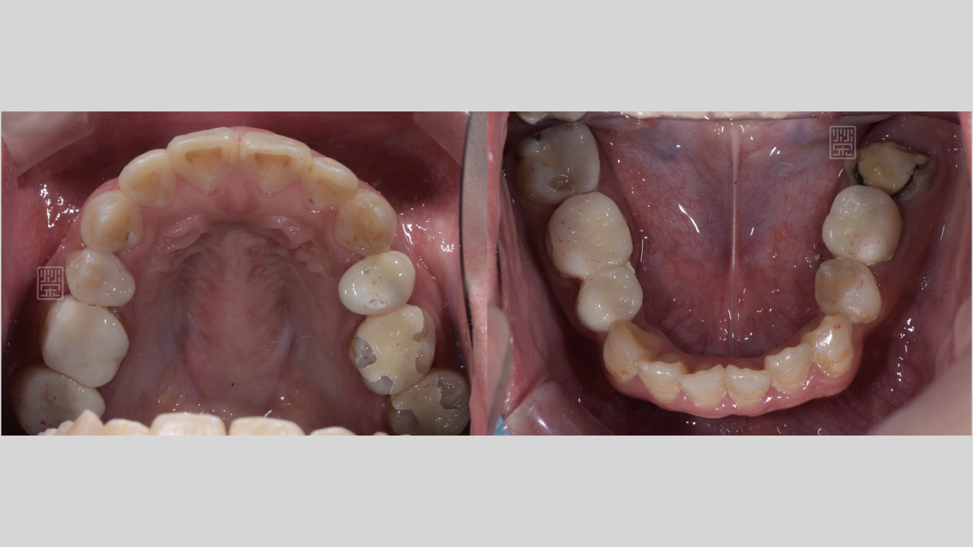 重新樹脂填補完畢