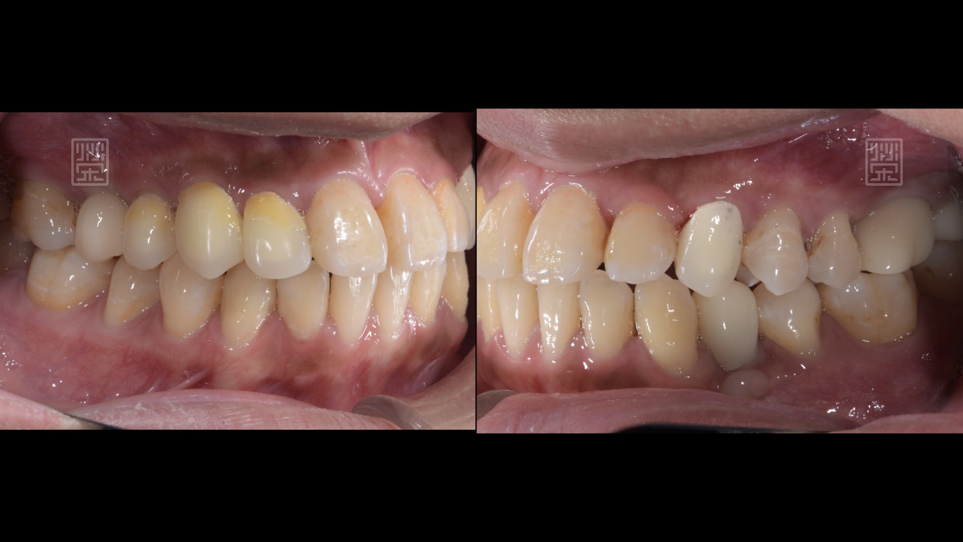 奈米樹脂、臨時假牙、植牙修復