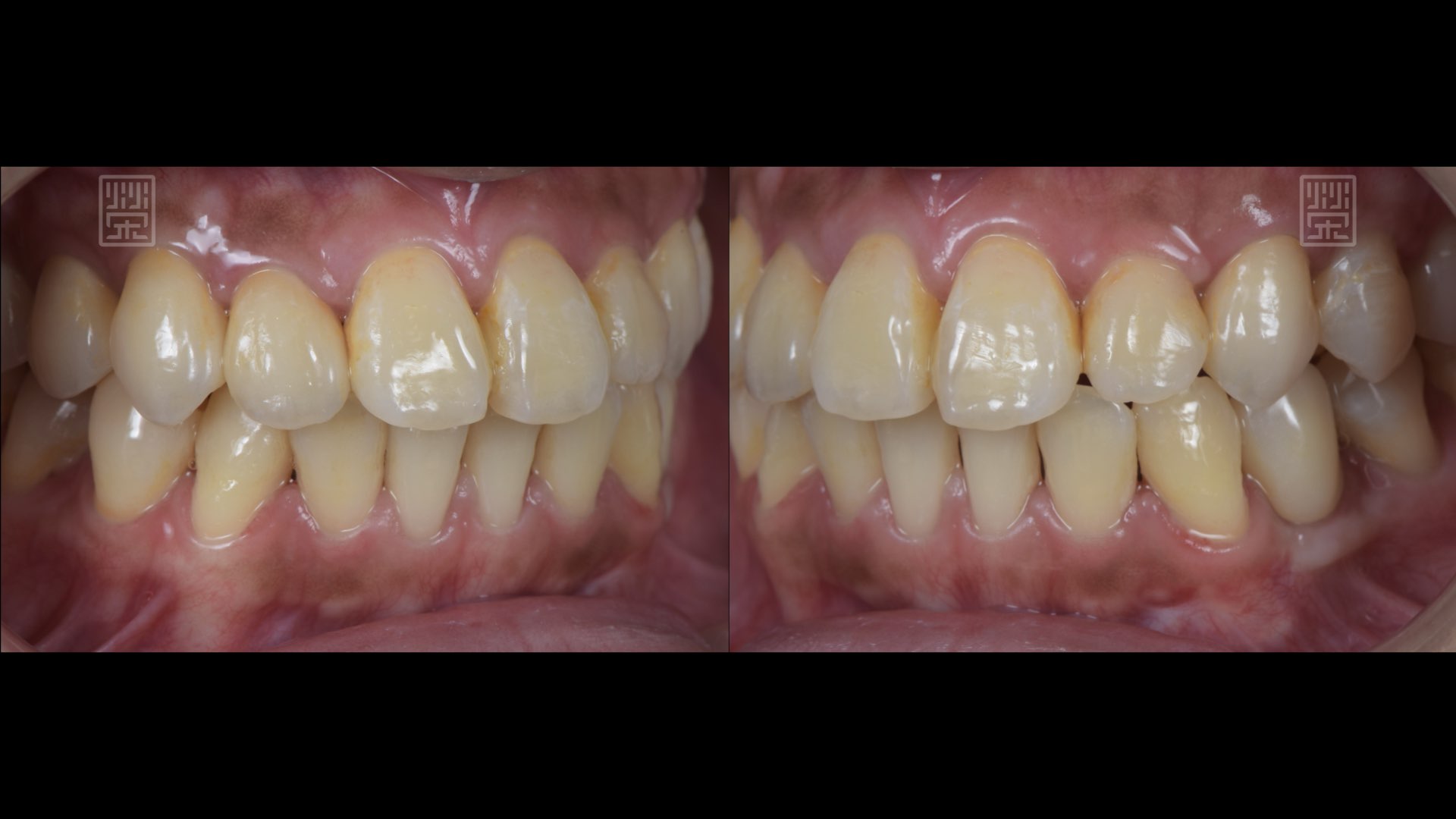 全瓷冠、植牙修復完成