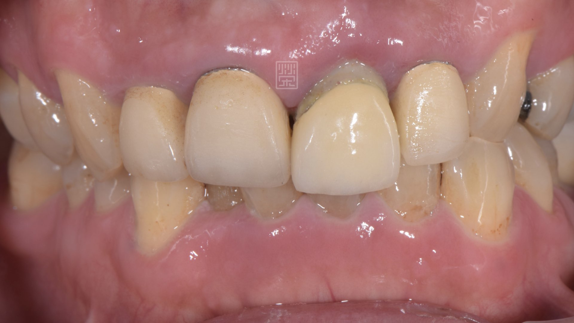 門齒斷裂造成掉下來