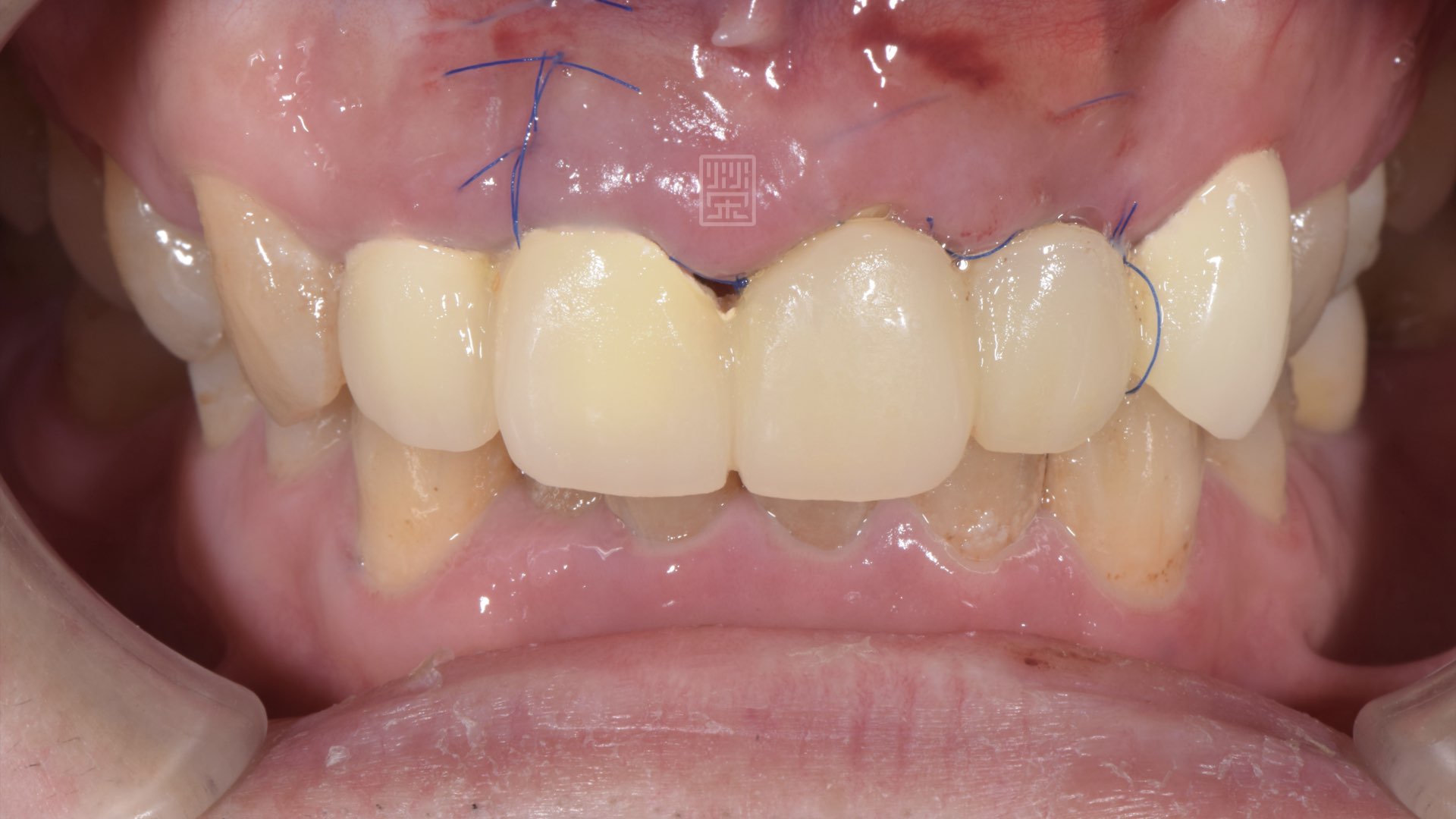 手術後傷口恢復