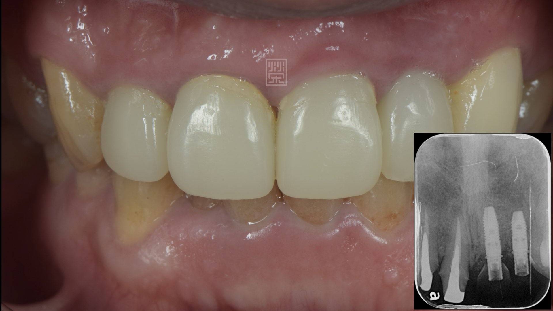 骨頭生長完成，植牙穩定後，接出臨時假牙