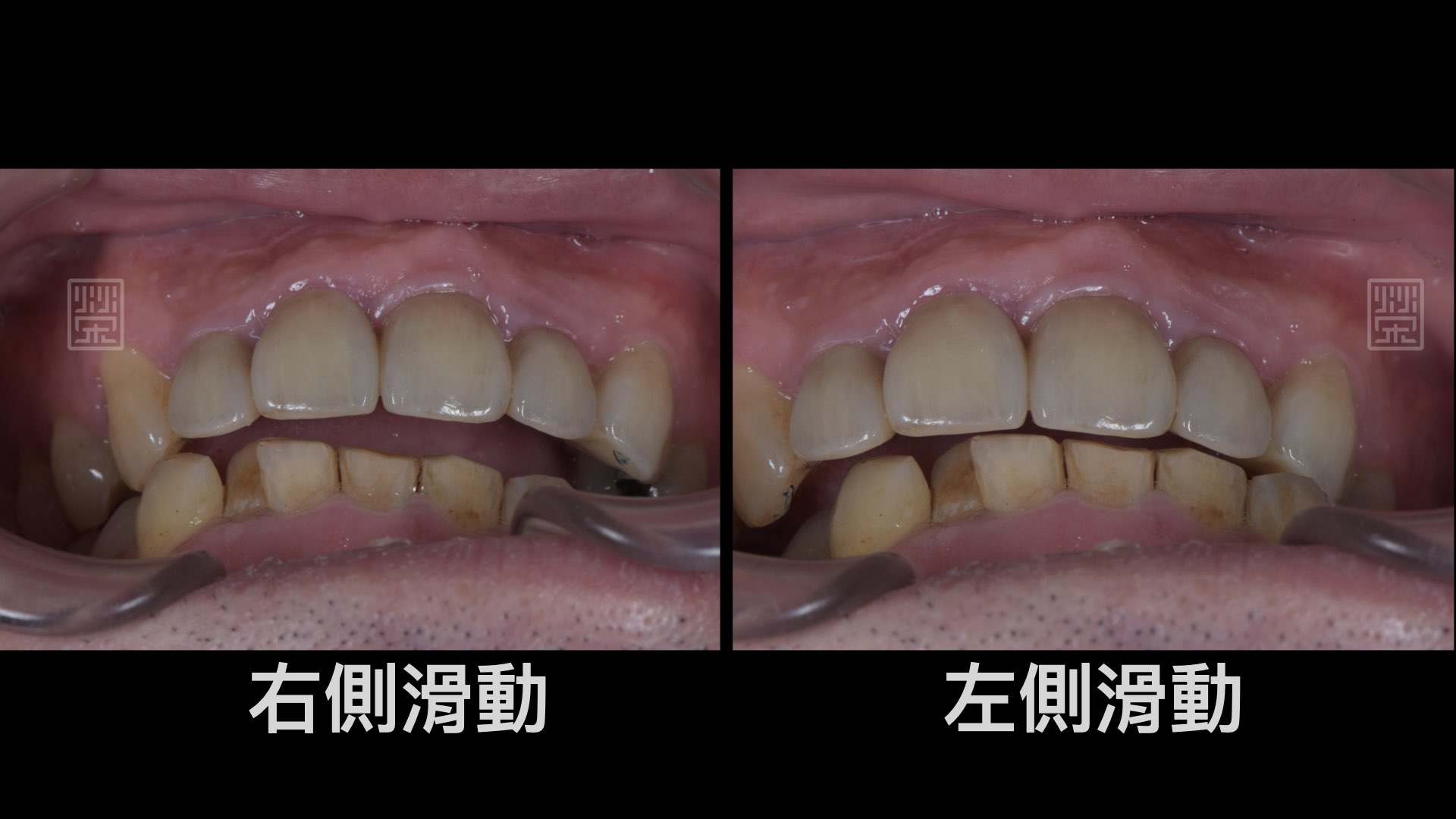 左側運動與右側運動皆有犬齒導引保護
