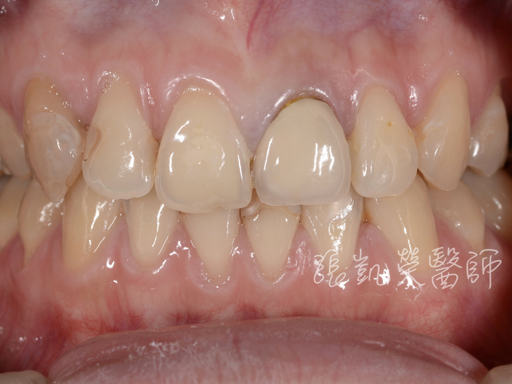 治療前，舊假牙邊緣黑黑的