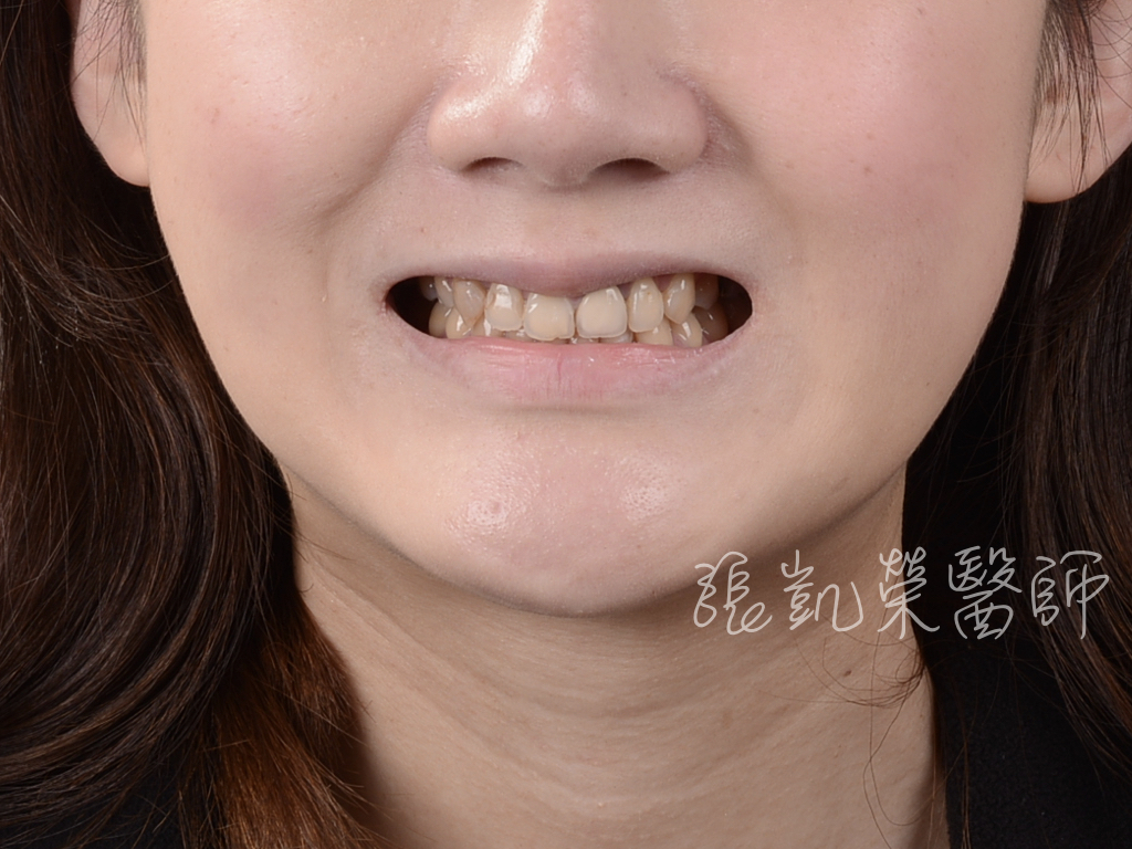 治療前，羞澀的笑容