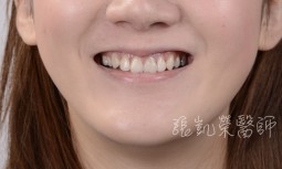 假牙變色，齒色暗沈---全瓷冠併全口美白