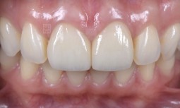 我矯正後門牙有縫開掉，該怎麼處理呢？---全瓷冠修復