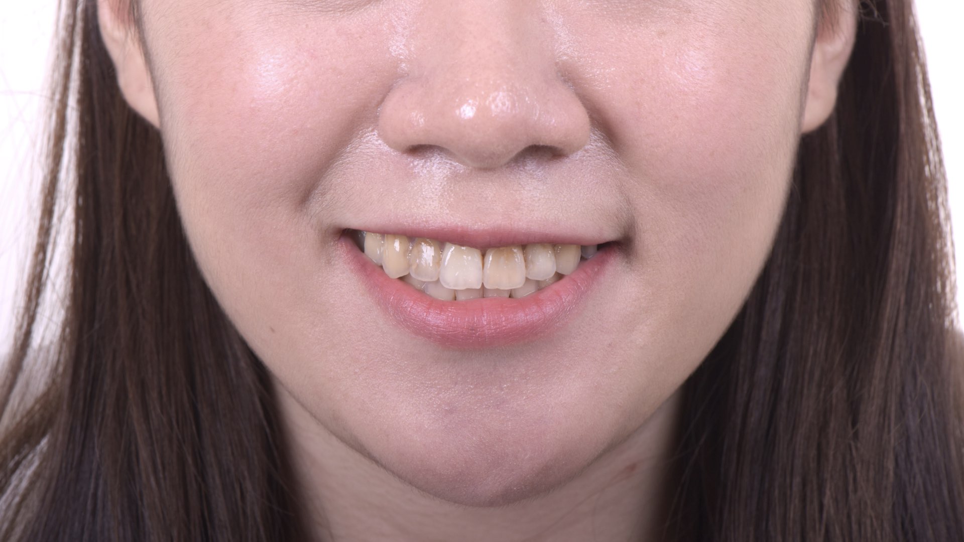 根管治療後牙齒變色