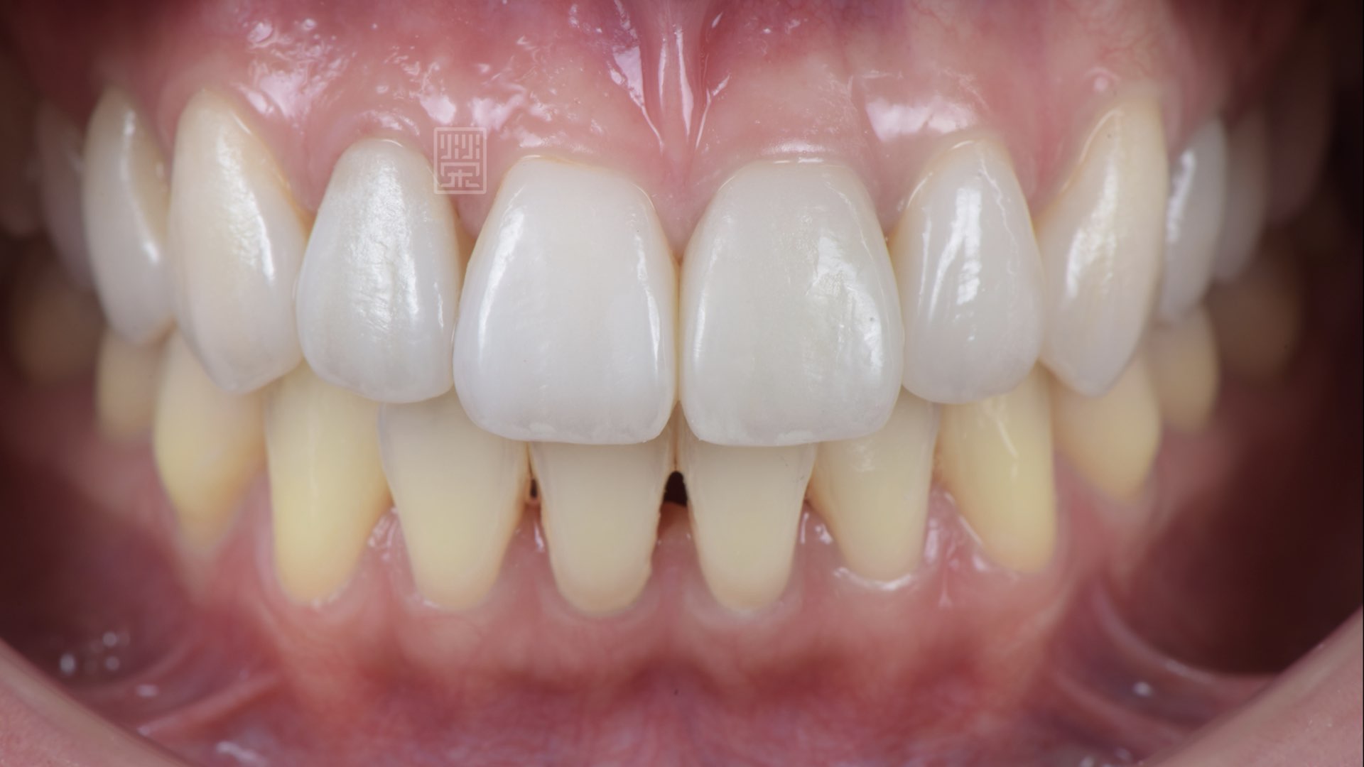 全瓷冠貼片完成