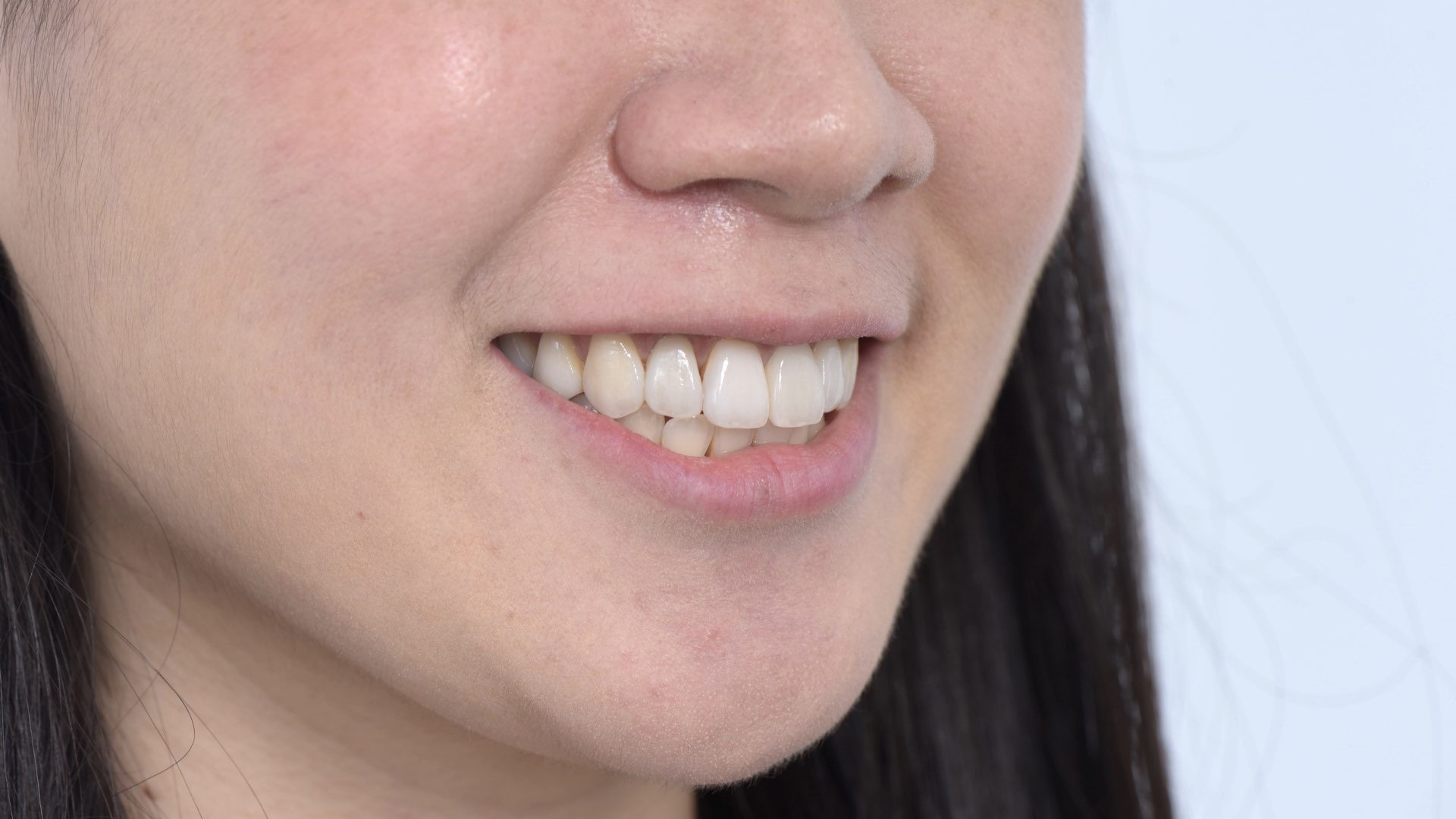 全瓷冠貼片完成